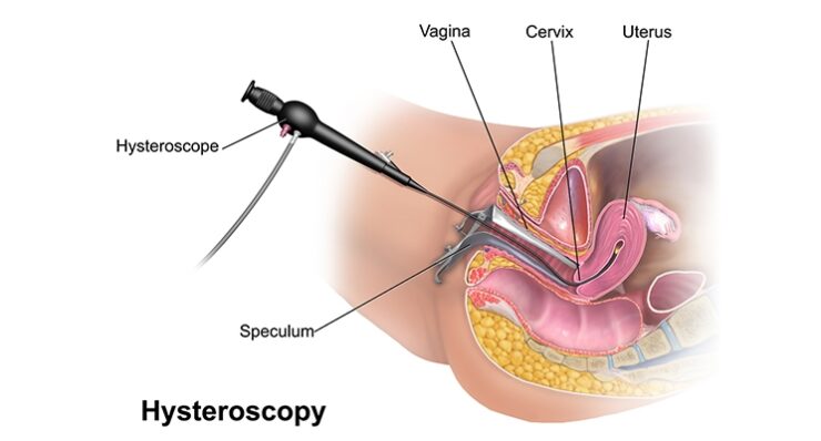 Hysterolaparoscopy: