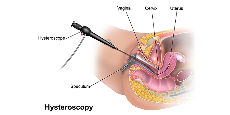 Hysterolaparoscopy: