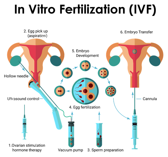Invitro Fertilization ( IVF )