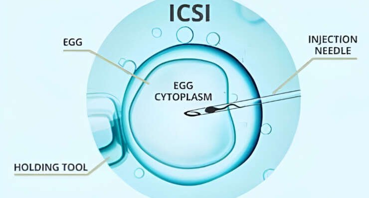 ICSI – Intracytoplasmic sperm injection
