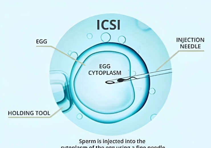 ICSI – Intracytoplasmic sperm injection