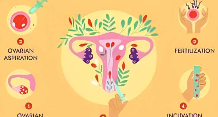 IVF – In vitro Fertilisation