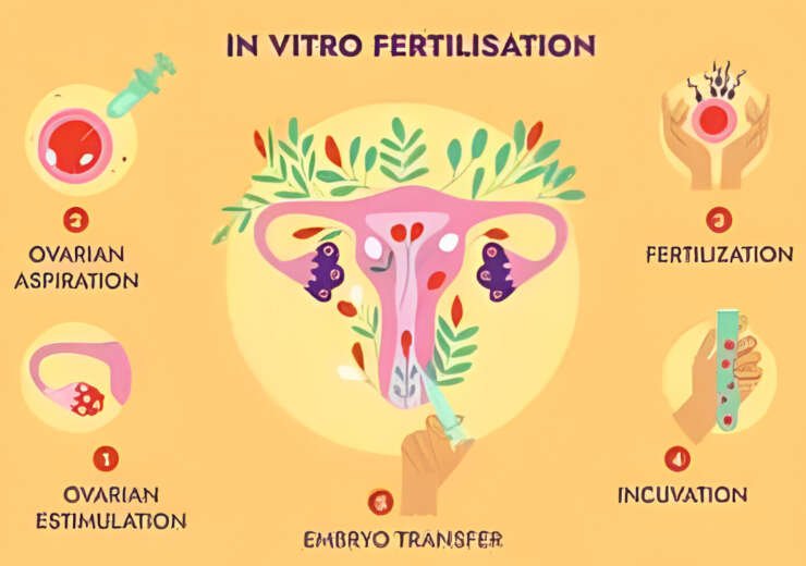 IVF – In vitro Fertilisation
